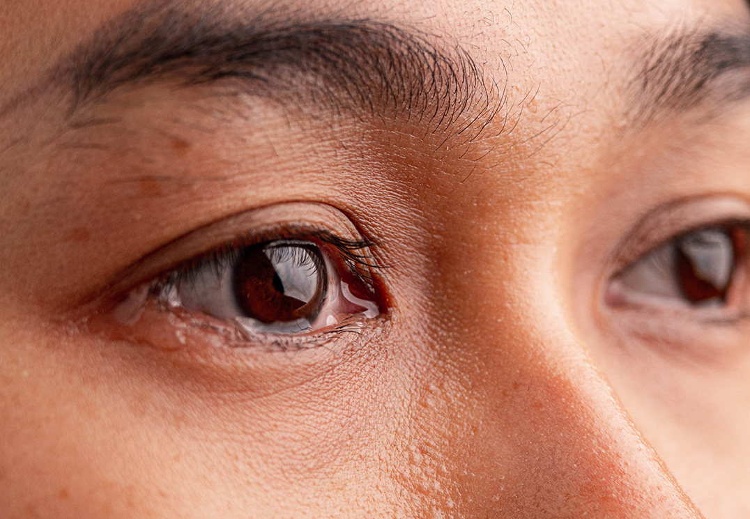 Close-up of a woman with persistently watery eyes caused by excessive tearing.