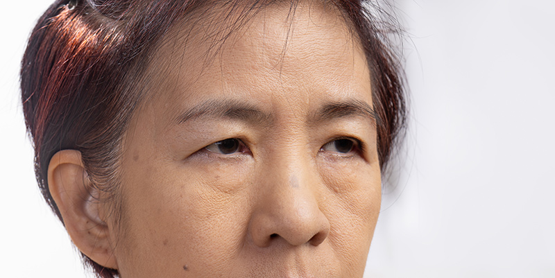 Signs You May Need Droopy Eyelid Surgery